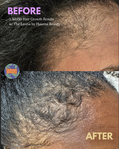 The Leona by Haiama Beauty | Red Light Therapy For Hair Growth